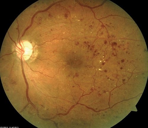 An image of a fundus showing signs of diabetic retinopathy. Computer vision models are now better than humans at picking up on indicators of diabetes from images such as this. Image source: Review of Optometry